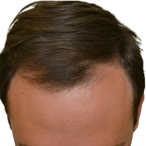 אחרי טיפול מינוקסידיל