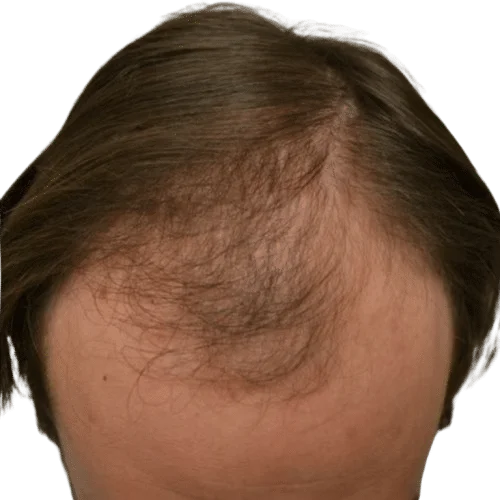 לפני טיפול מינוקסידיל
