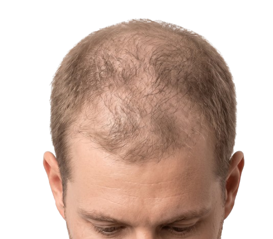 לפני הטיפול במינוקסידיל